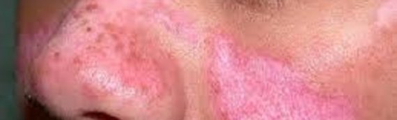 10 biểu hiện của bệnh lupus ban đỏ hệ thống không thể bỏ qua