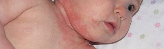 Nguyên nhân và cách phòng bệnh viêm da tiếp xúc ở trẻ em